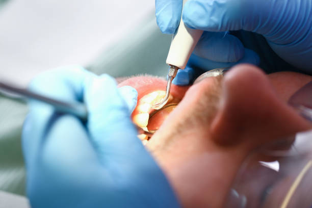 Teeth Whitening in CT